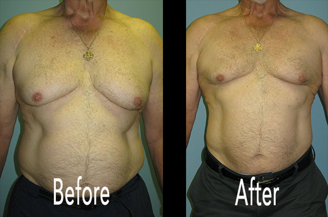 Teenage boy with B-cup sized 'moobs' has breast reduction
